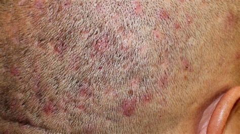 Best results are said to occur if a show cap is worn. . Natural hair scabs on scalp
